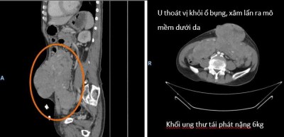 “ĐỪNG CHỦ QUAN VỚI UNG THƯ ĐÃ ĐIỀU TRỊ - KHỐI U 6KG TRONG Ổ BỤNG TÁI PHÁT SAU ĐIỀU TRỊ”