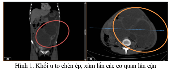 CẢNH GIÁC KHI BỤNG TO BẤT THƯỜNG “DẤU HIỆU CẢNH BÁO UNG THƯ BUỒNG TRỨNG”